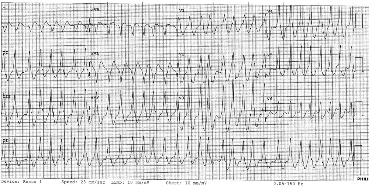 ECG for young man with palpitations and presyncope