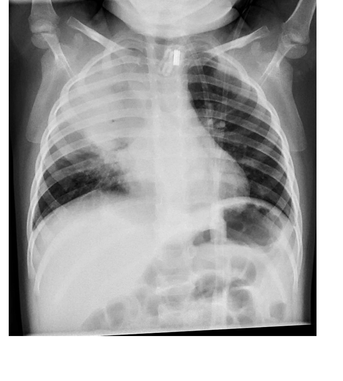 Paediatric chest X-ray for fever and breathing difficulty