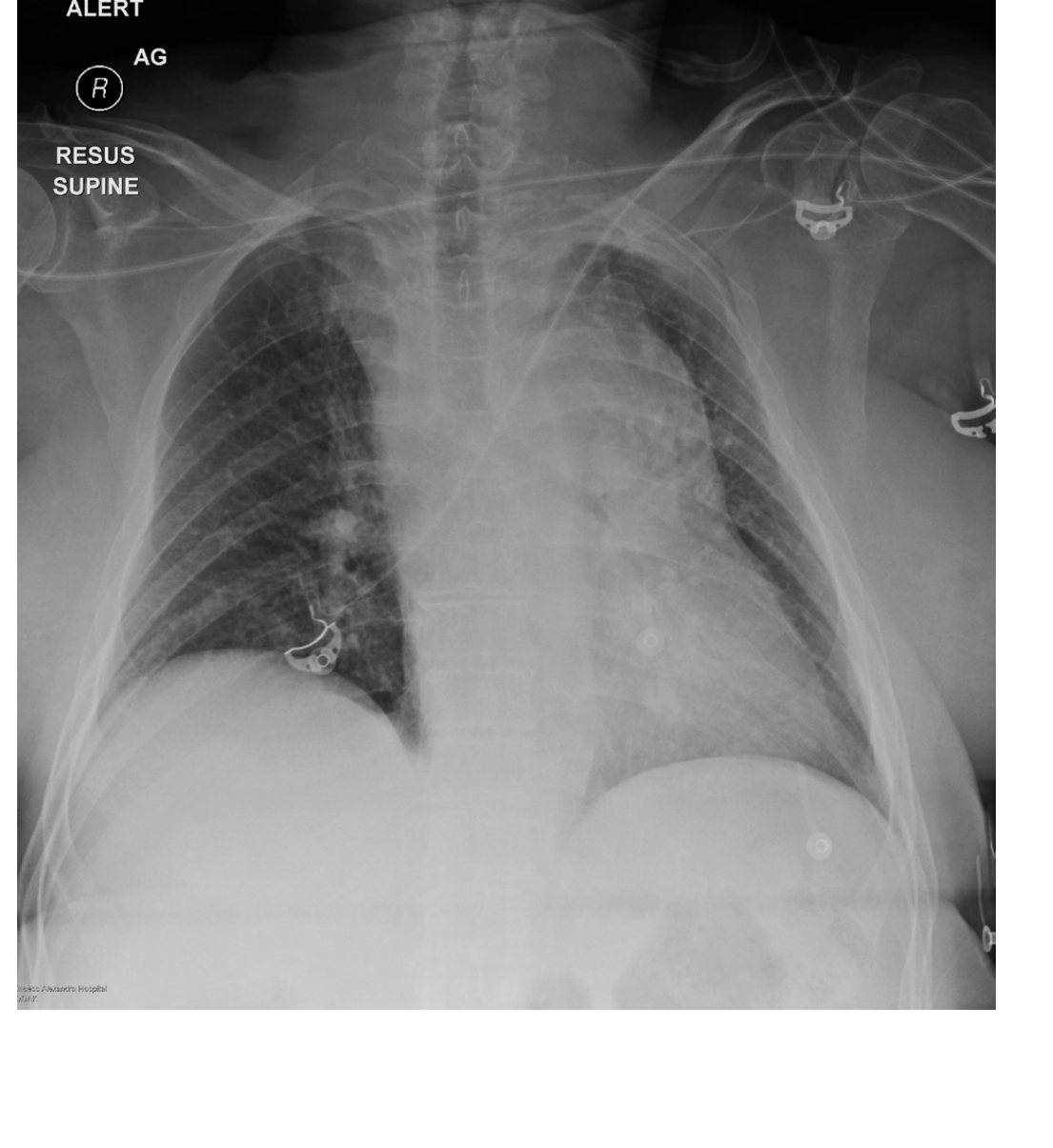 Supine chest X-ray after high-speed trauma
