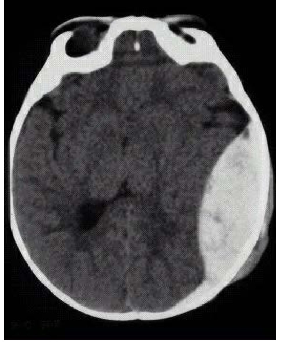 CT brain slice after paediatric head injury