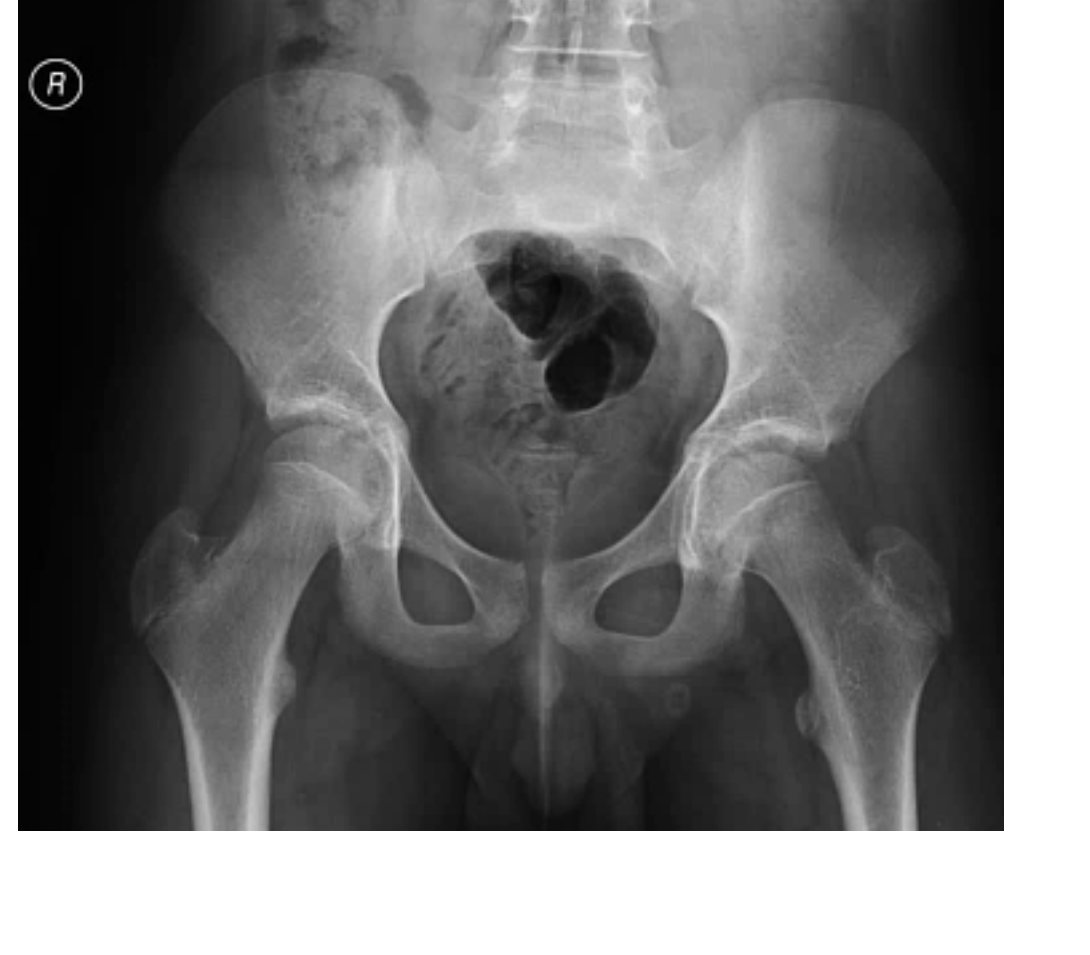 Pelvis and hip X-ray for child with limp and hip pain