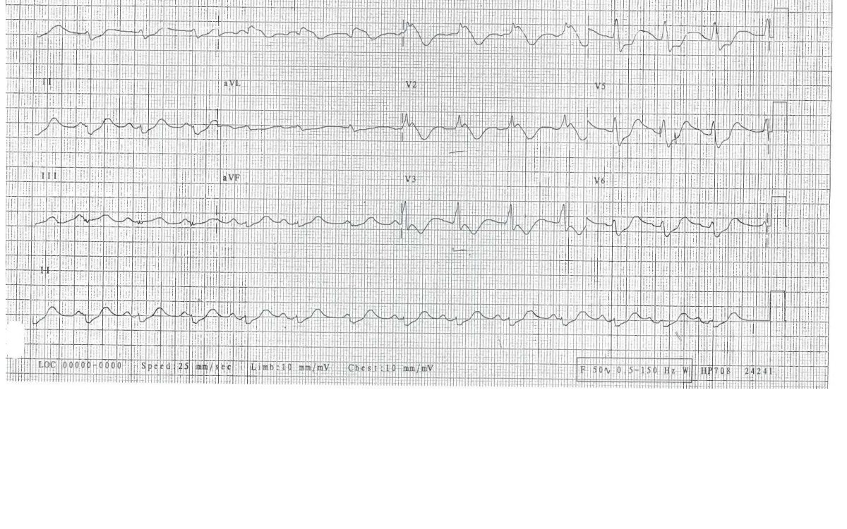 ECG after unspecified overdose