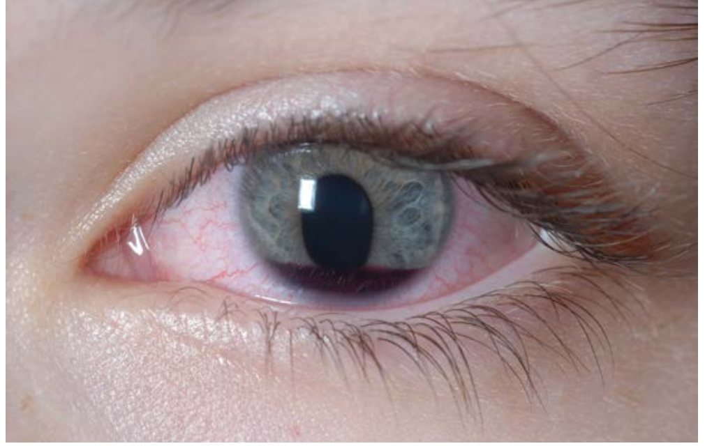 Eye photograph after angle-grinder injury