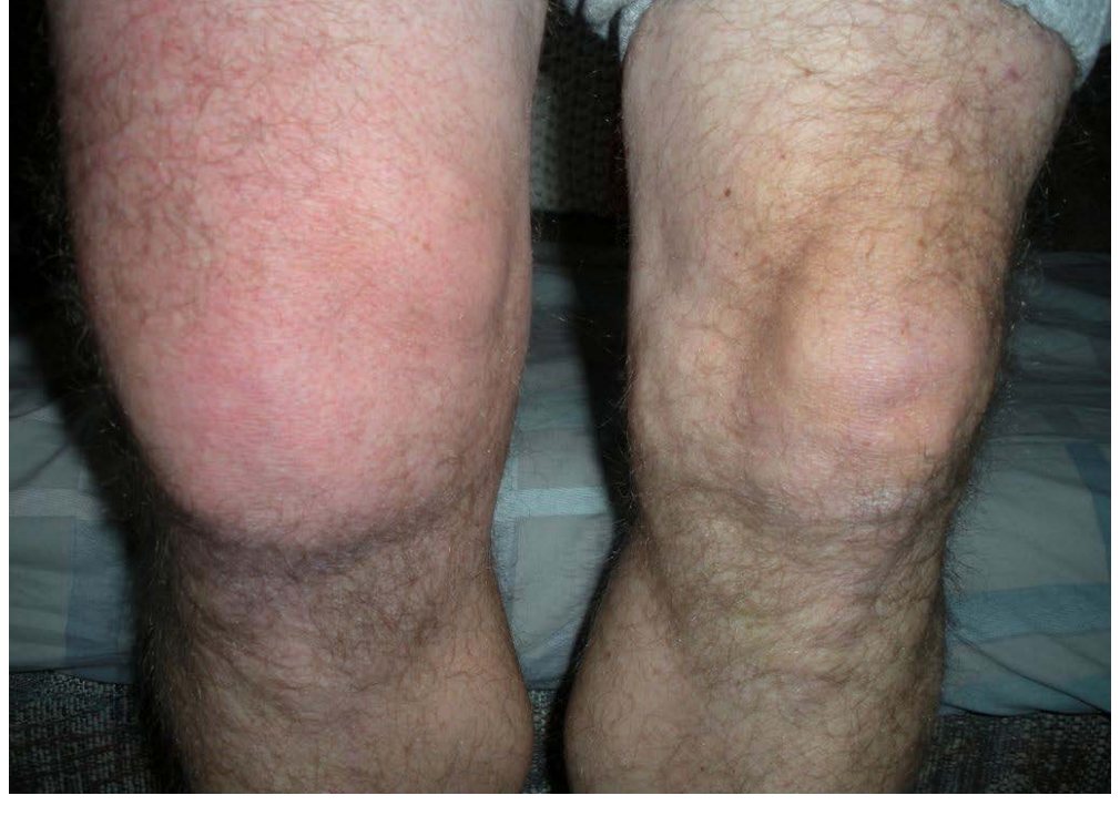 Photograph of atraumatic painful right knee
