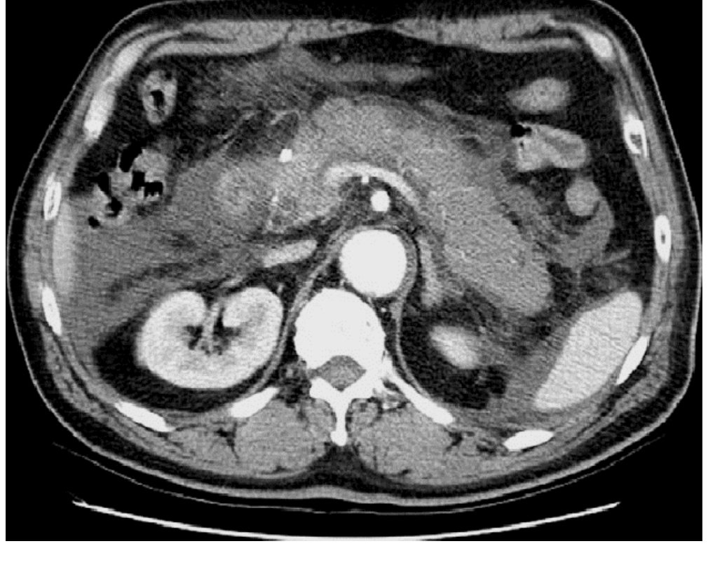 CT abdomen for epigastric pain