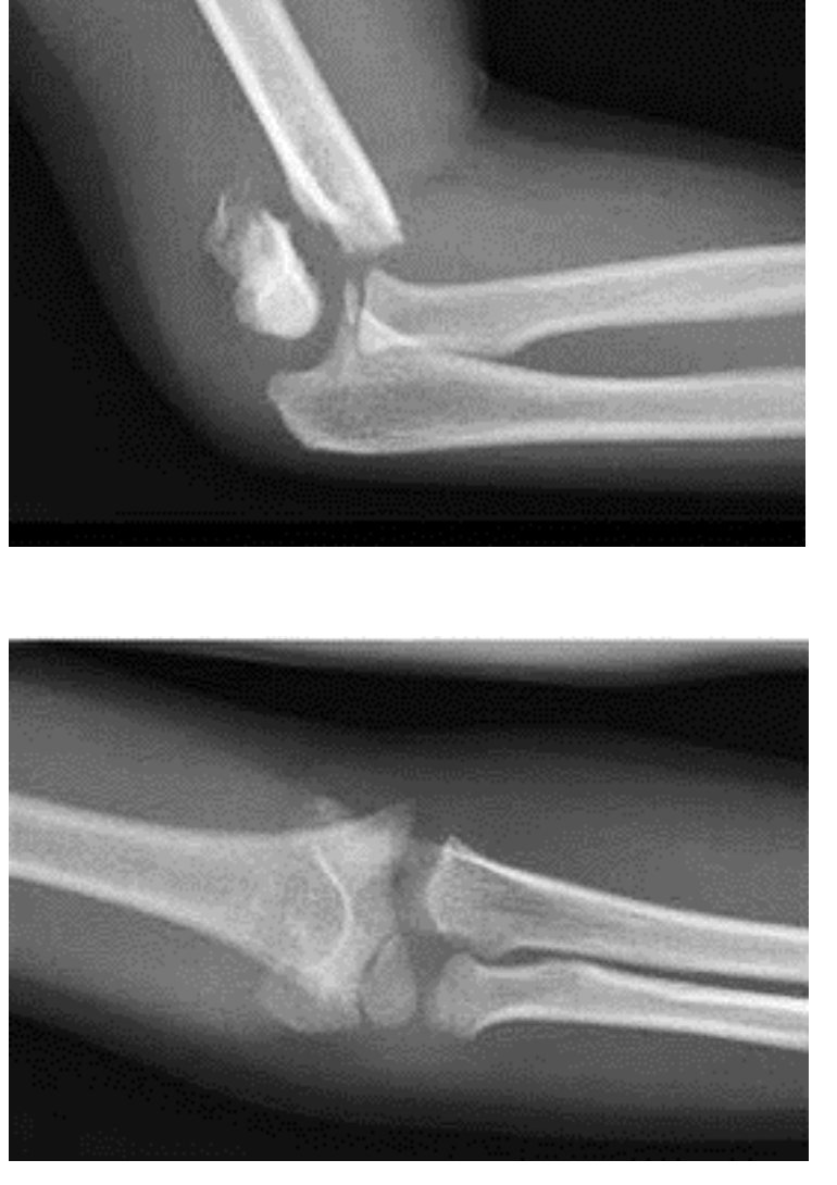 Elbow X-rays after fall from fence