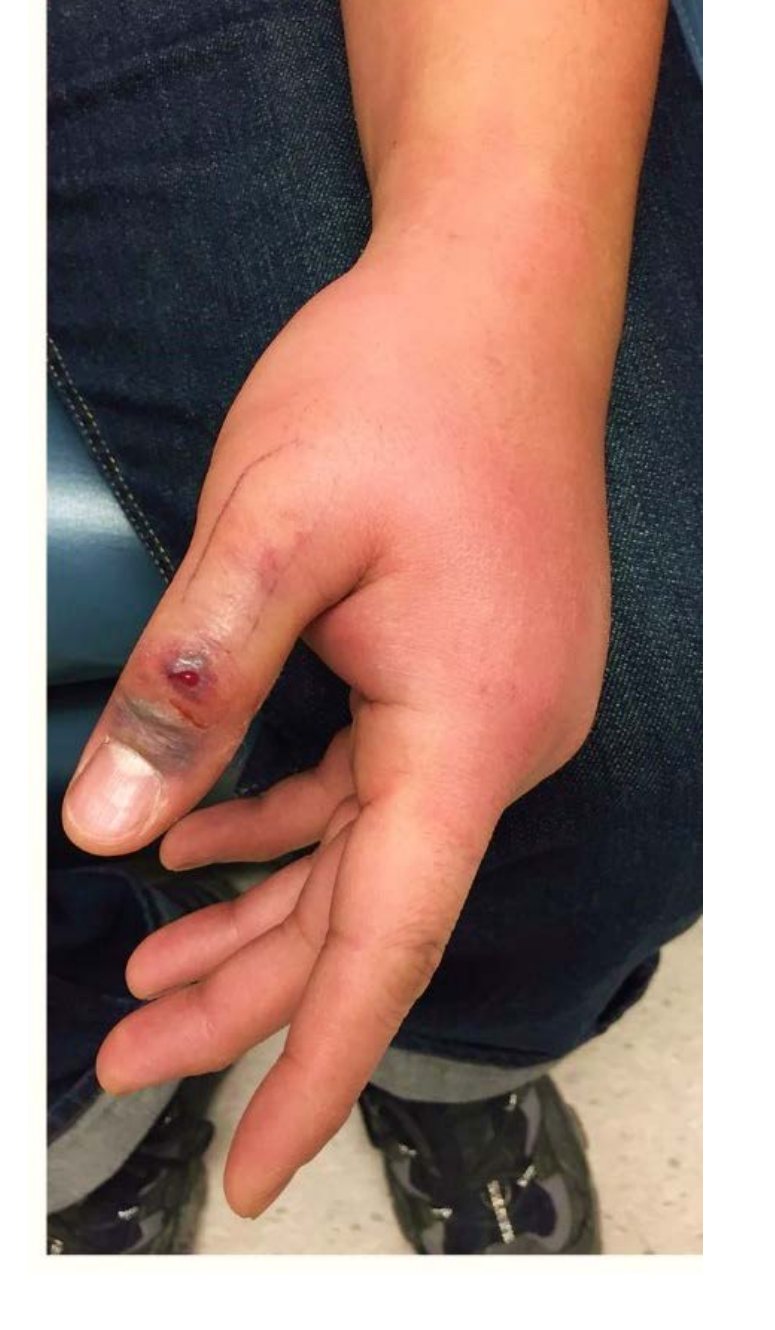 Left hand and thumb photograph after fish-hook injury
