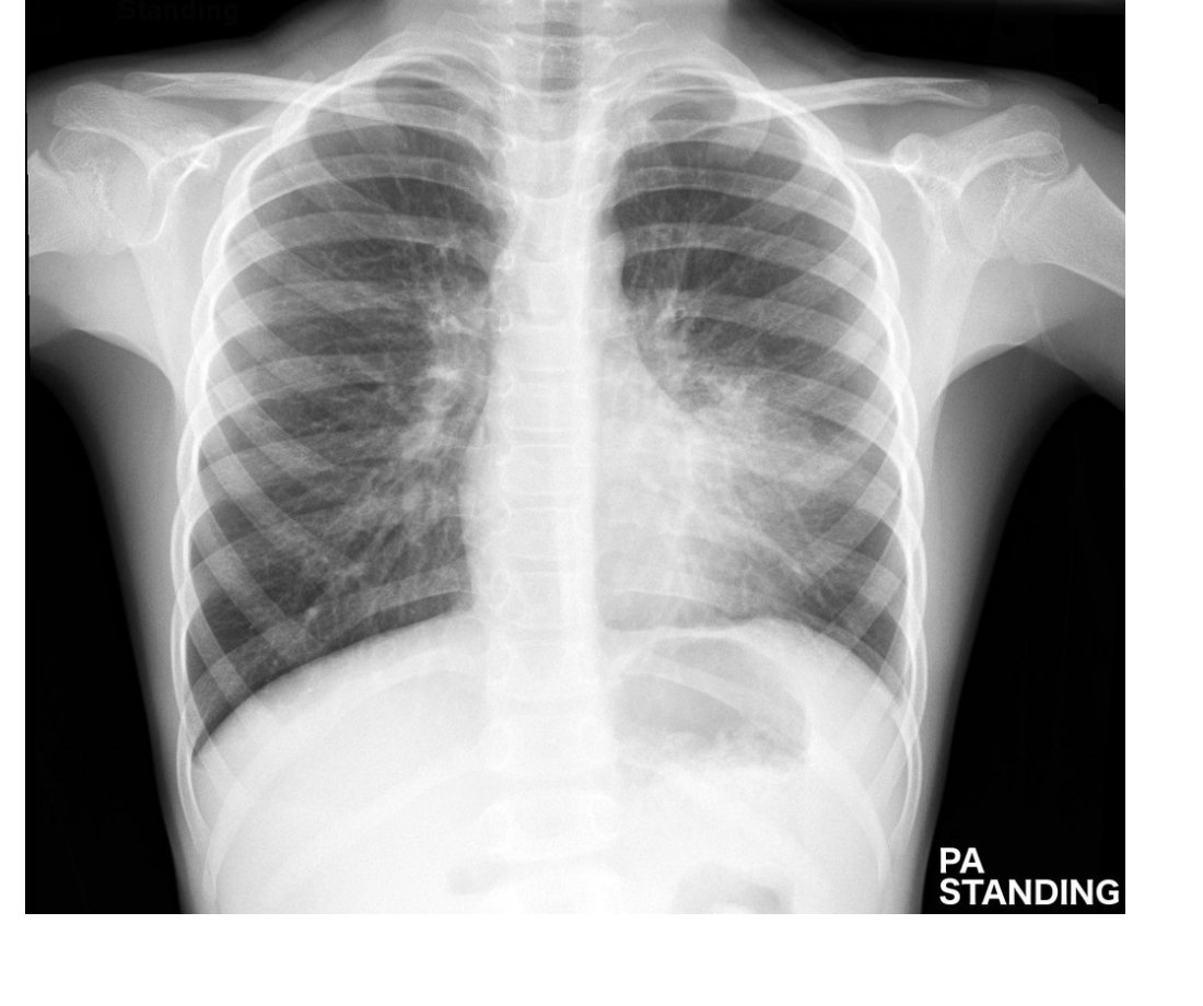 Chest X-ray for child with fever and cough
