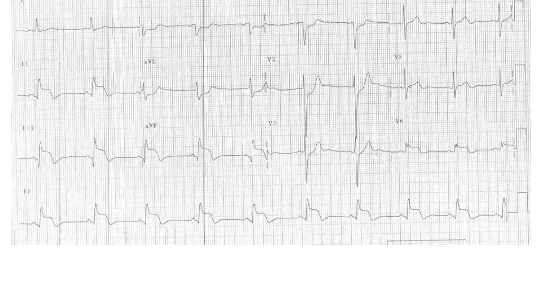 ECG for woman with central chest pain