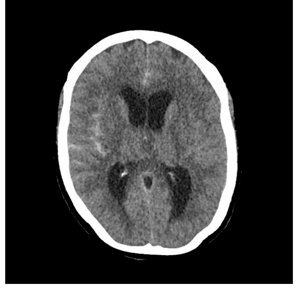 CT brain slice for patient with severe headache