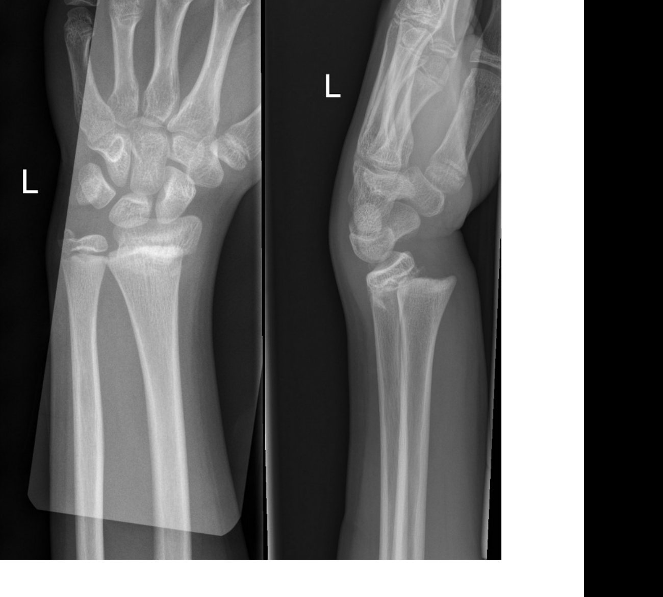 Wrist X-rays after playground fall