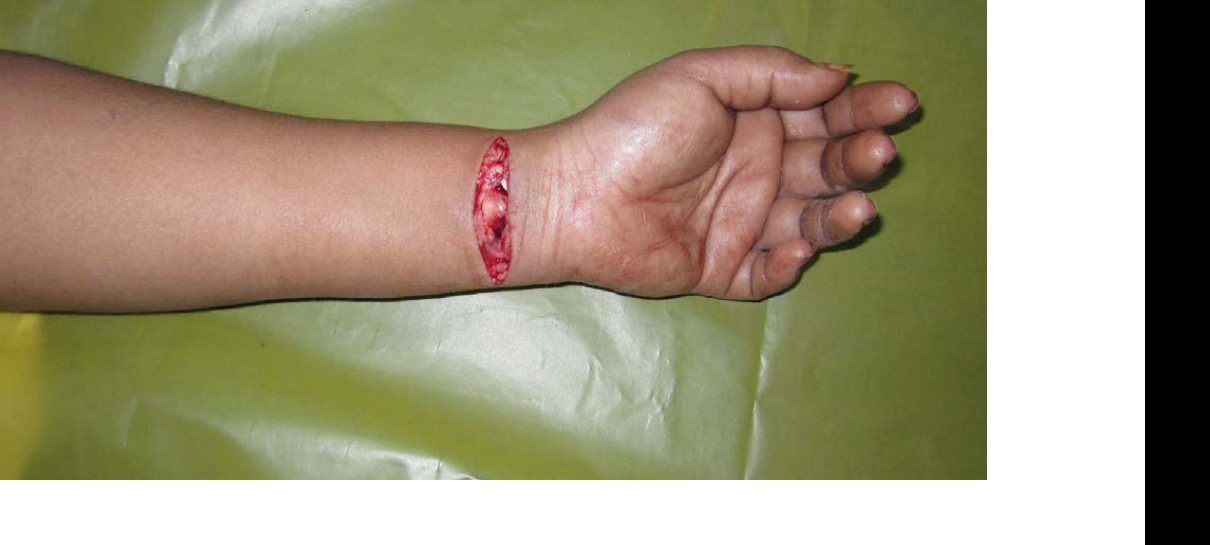 Clinical photograph of left wrist wound after self-harm