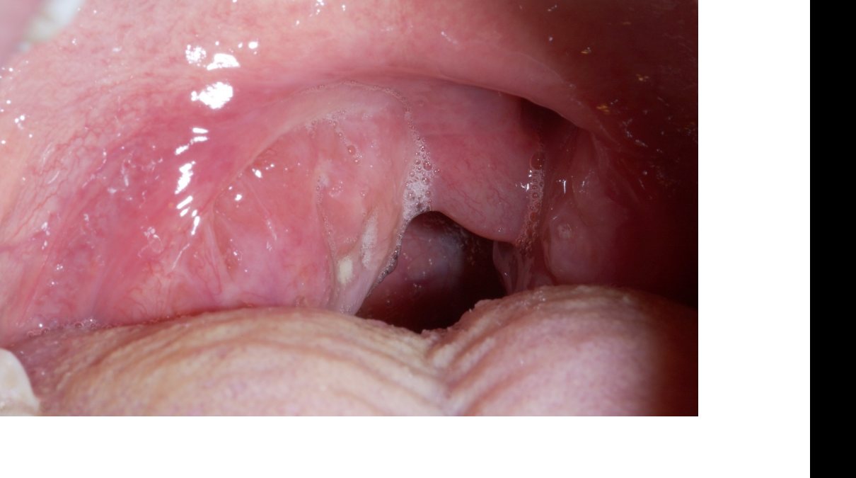 Oropharynx photograph for child with sore throat