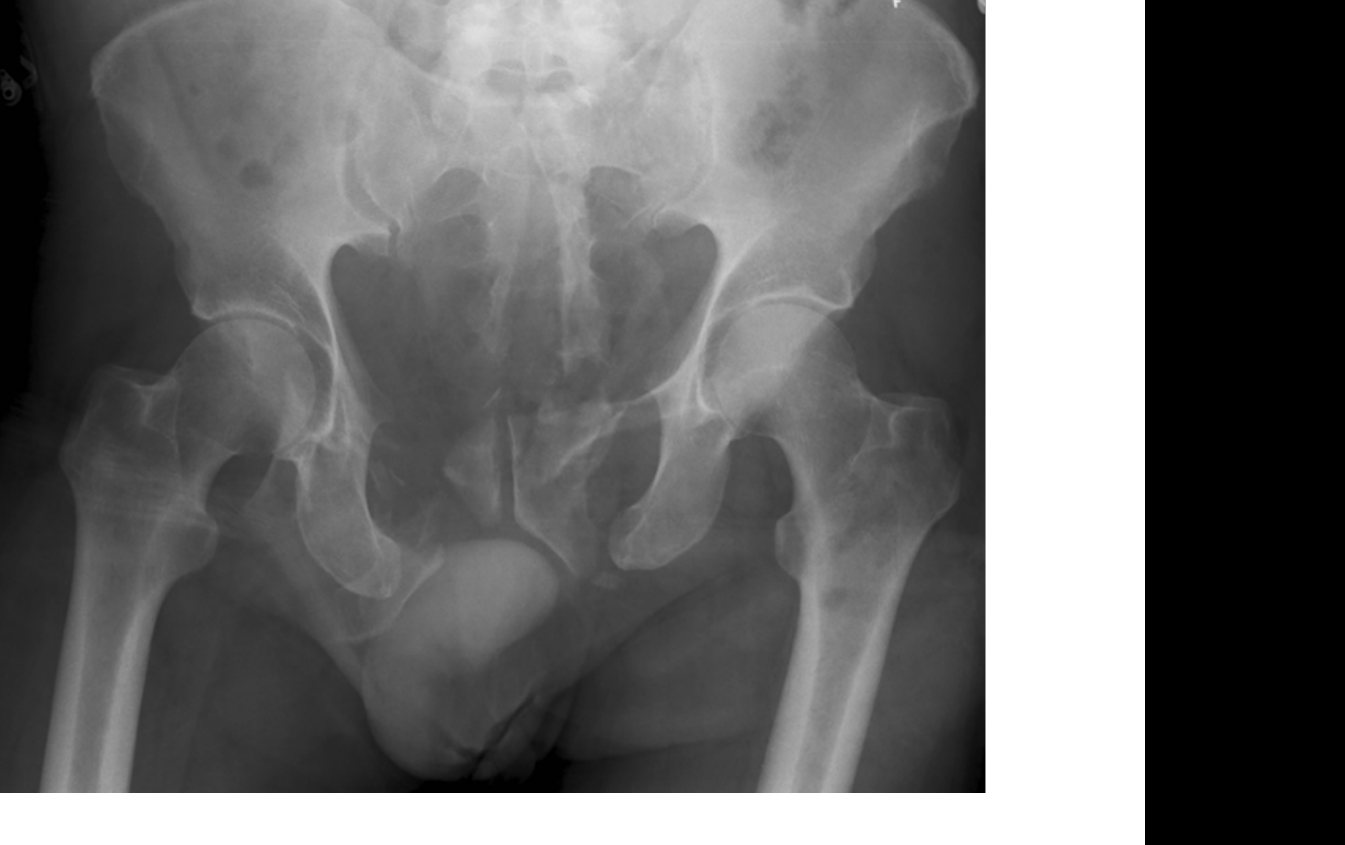 Pelvis X-ray after fall from ladder