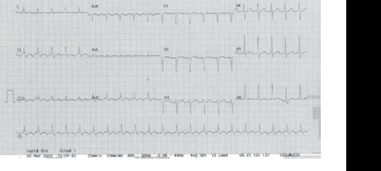 ECG for patient with palpitations and shortness of breath