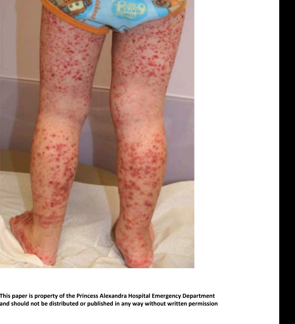 Clinical photograph of lower limb rash in a child