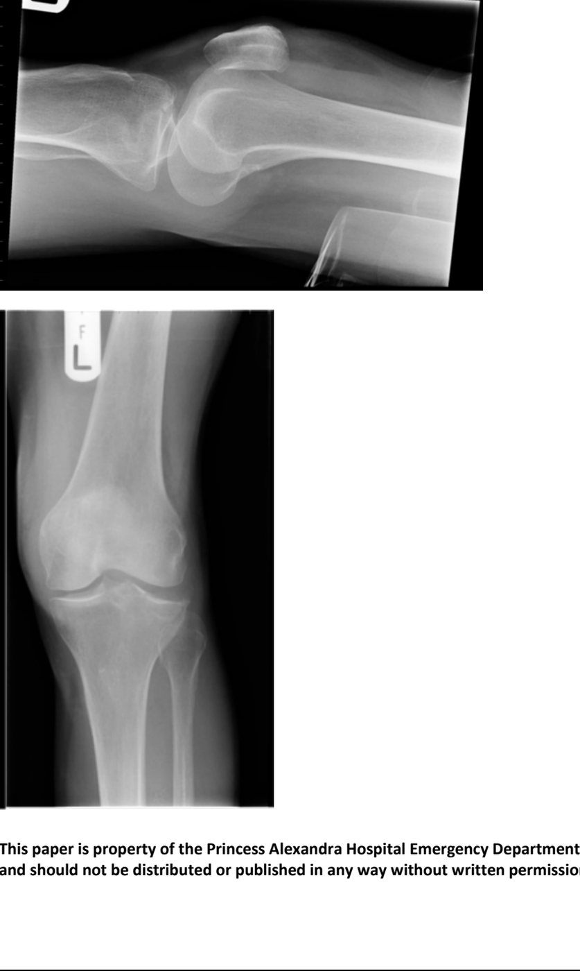Left knee X-rays after football injury