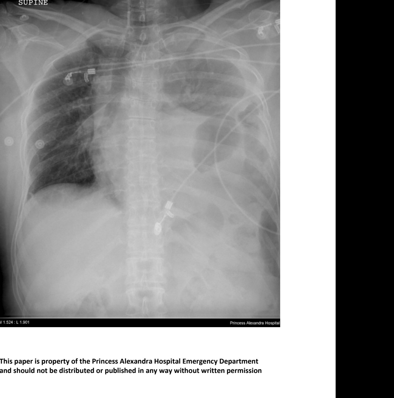 Supine chest X-ray after blunt trauma