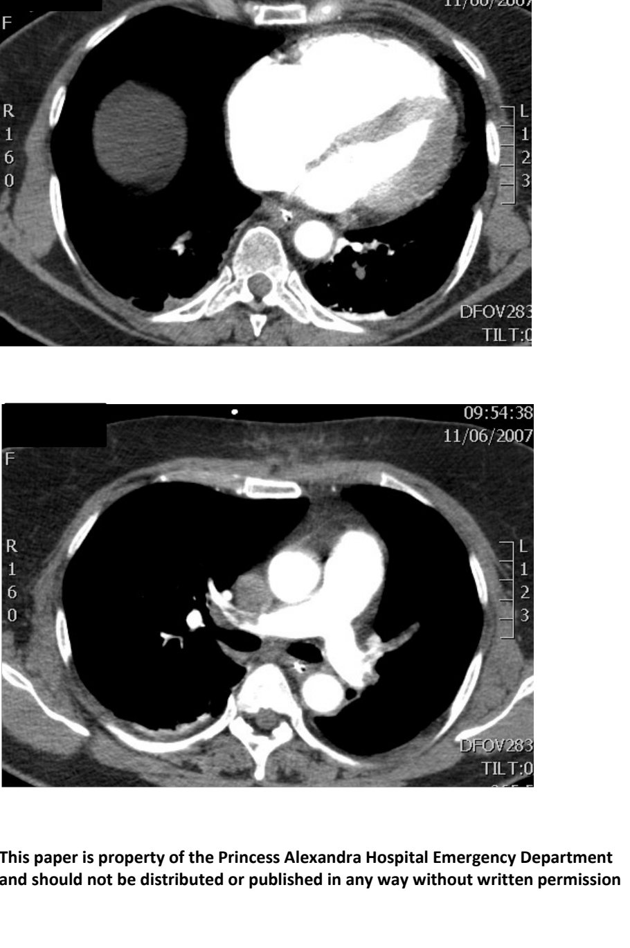 CT chest slices for patient with severe chest pain and dyspnoea