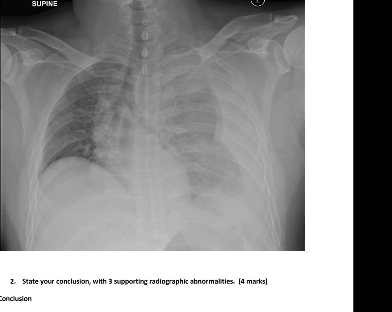 Supine chest X-ray after penetrating trauma