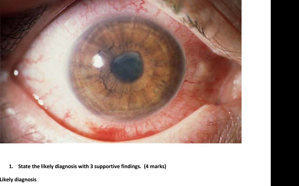 Clinical photograph of painful red eye