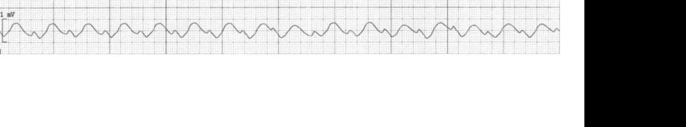 Cardiac monitor trace in an unresponsive renal patient