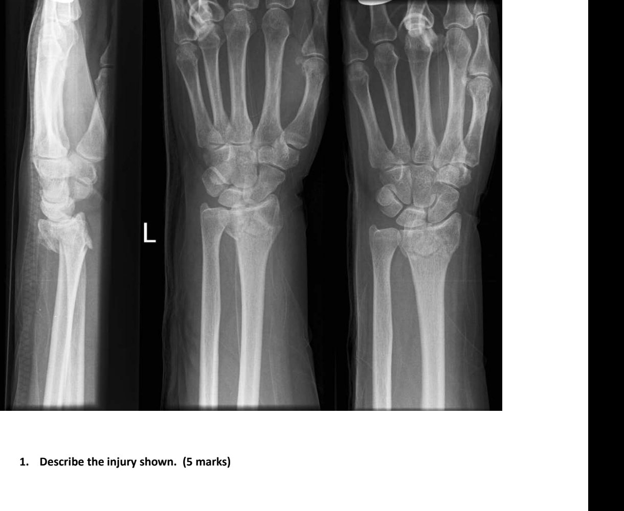 Left wrist X-rays after fall