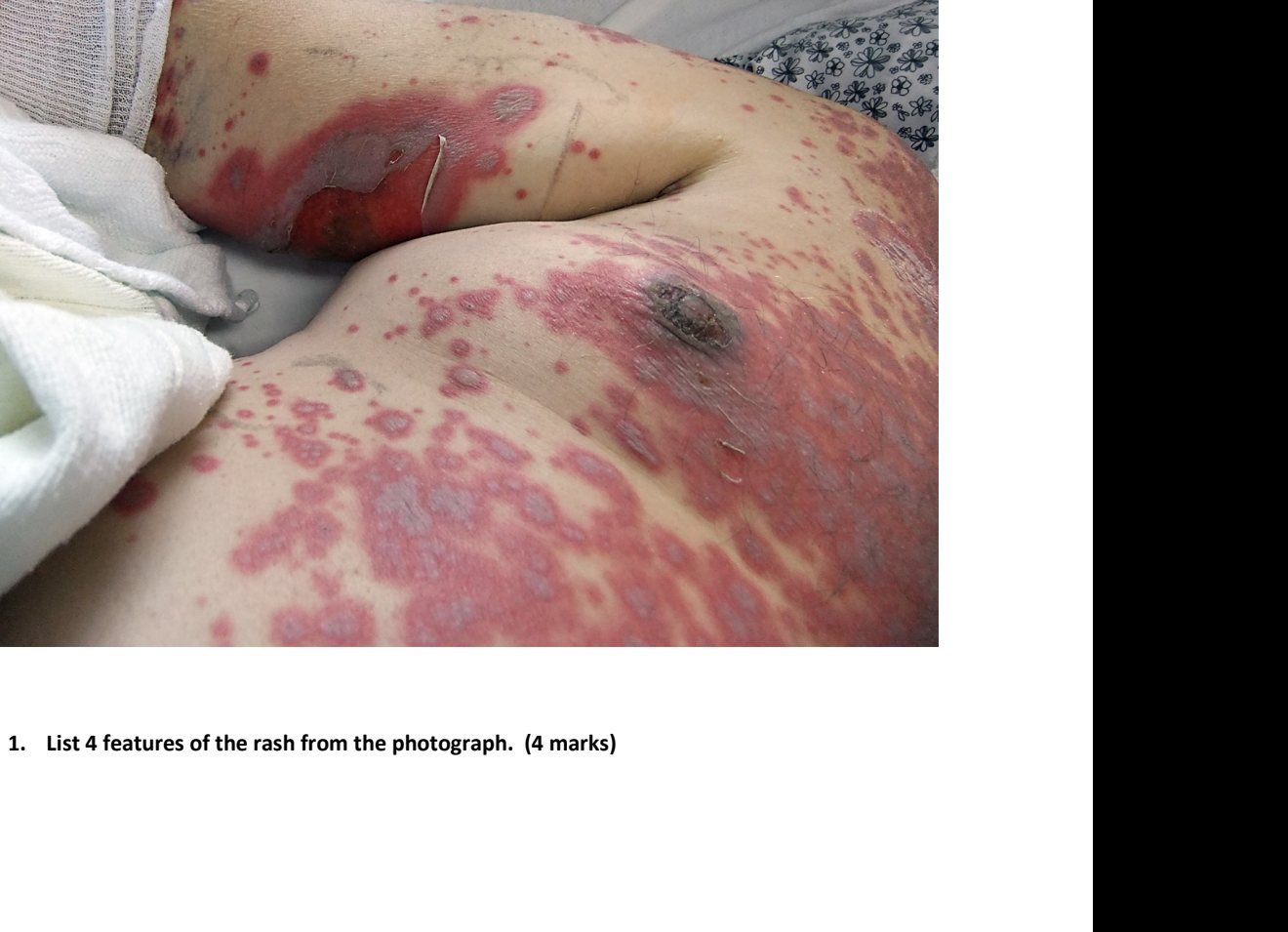 Clinical photograph of progressive blistering rash