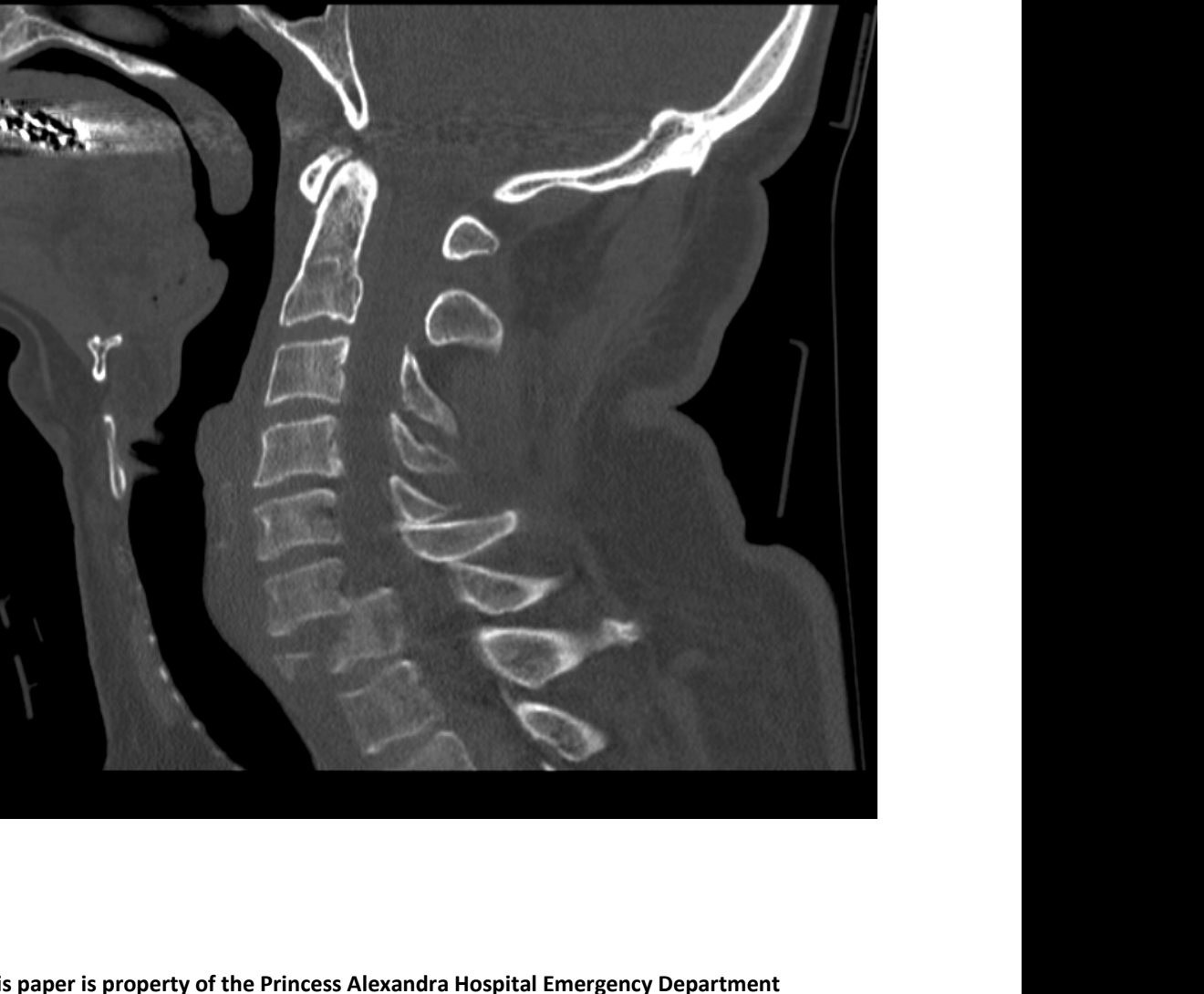 Sagittal CT cervical spine after fall
