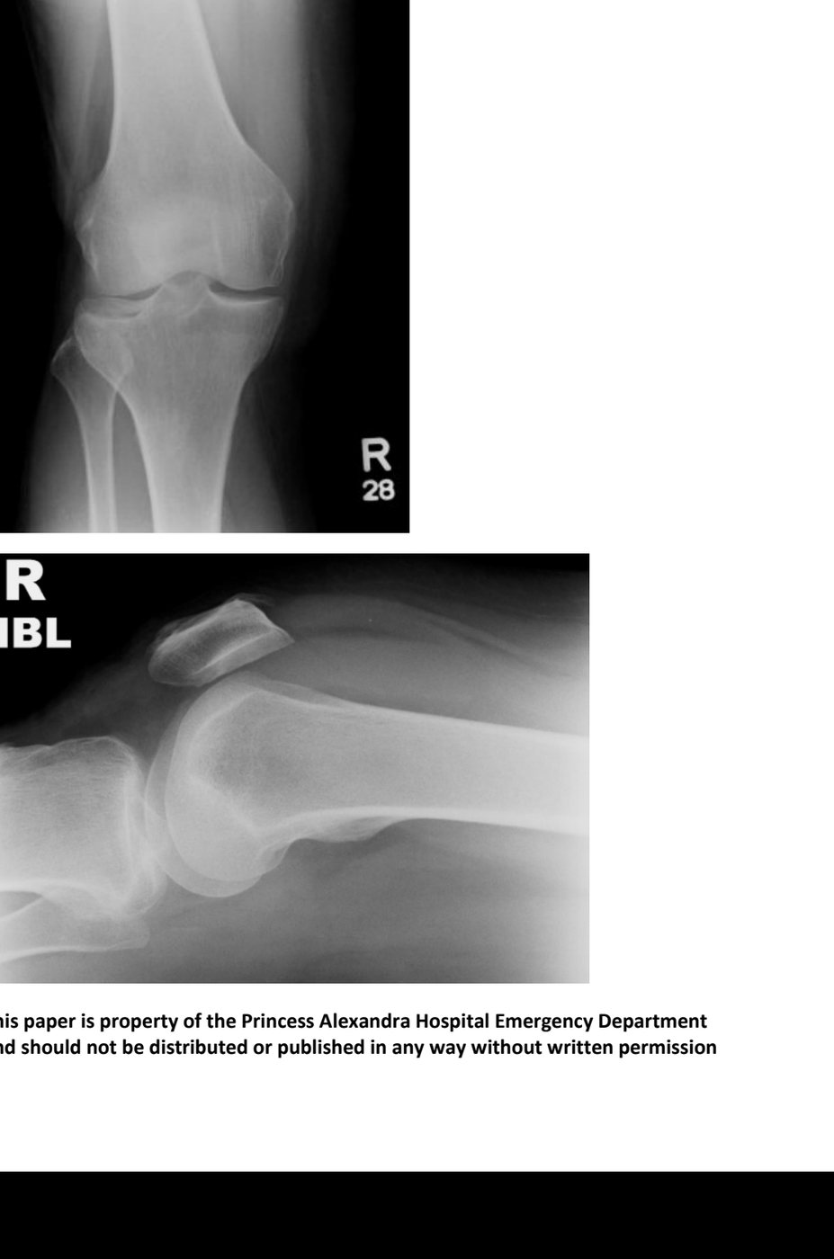Right knee X-rays after landing injury