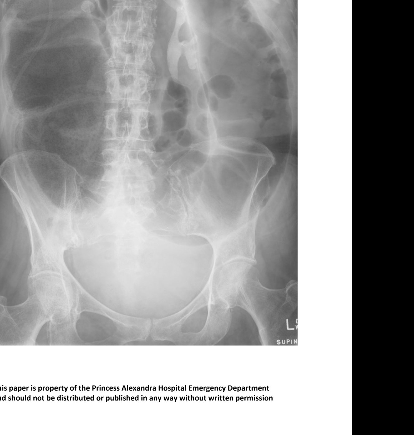 Abdominal X-ray in older patient with abdominal distension