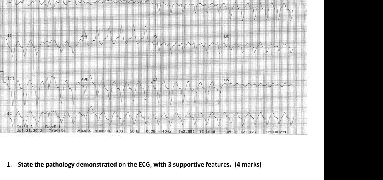 Twelve-lead ECG for chest pain and dizziness
