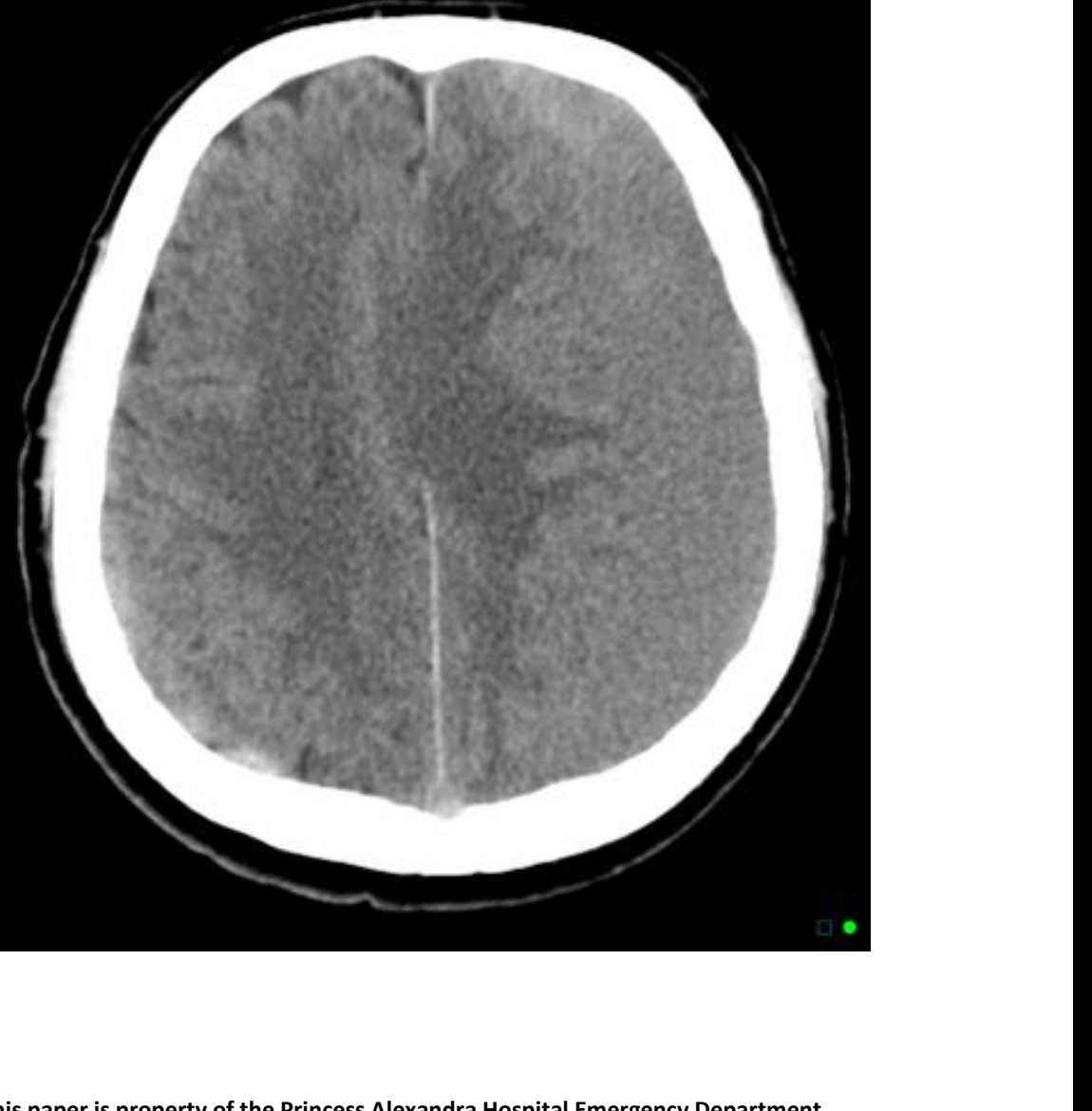 Axial CT head slice in older patient with confusion
