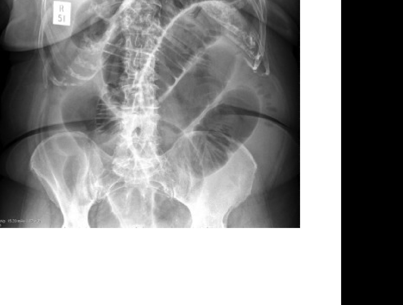 Abdominal X-ray in older patient with abdominal pain