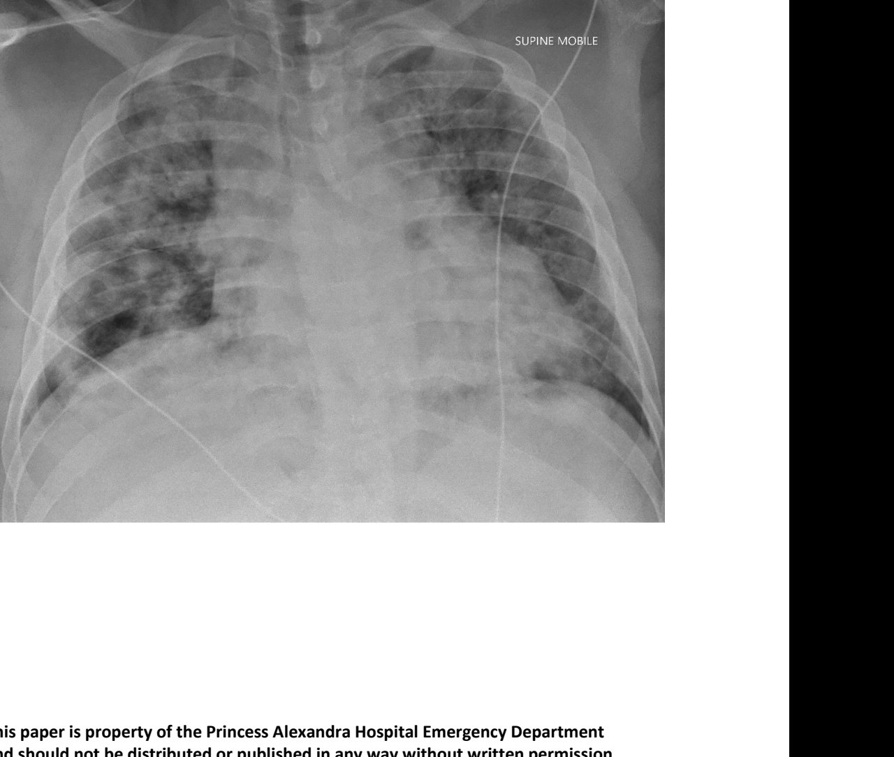 Portable chest X-ray for fever and dyspnoea