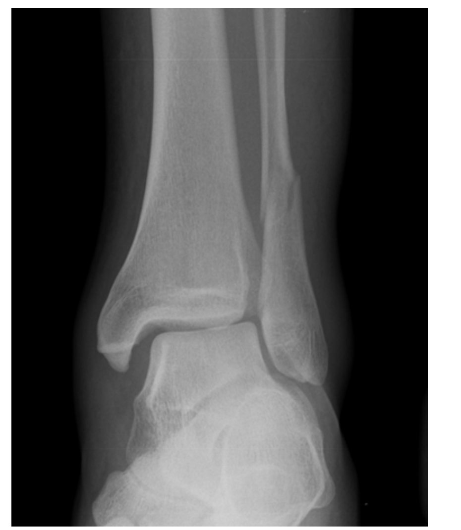 Left ankle X-ray after surfing accident