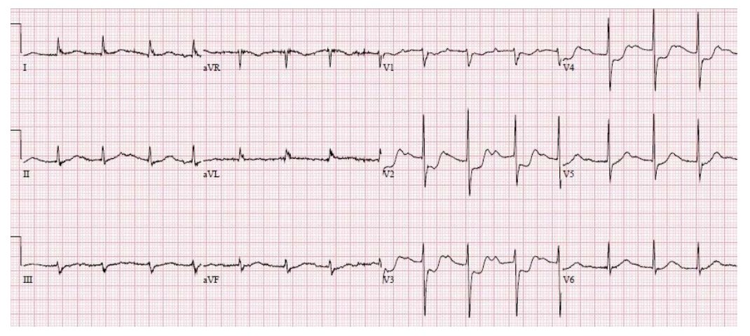 Twelve-lead ECG for chest pain