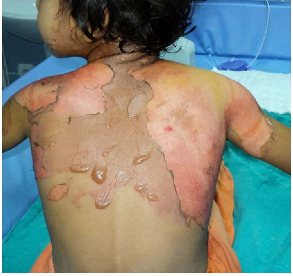 Clinical photograph of paediatric hot-water burns