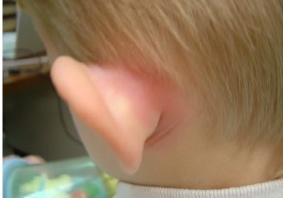 Clinical ear photograph after recent otitis media