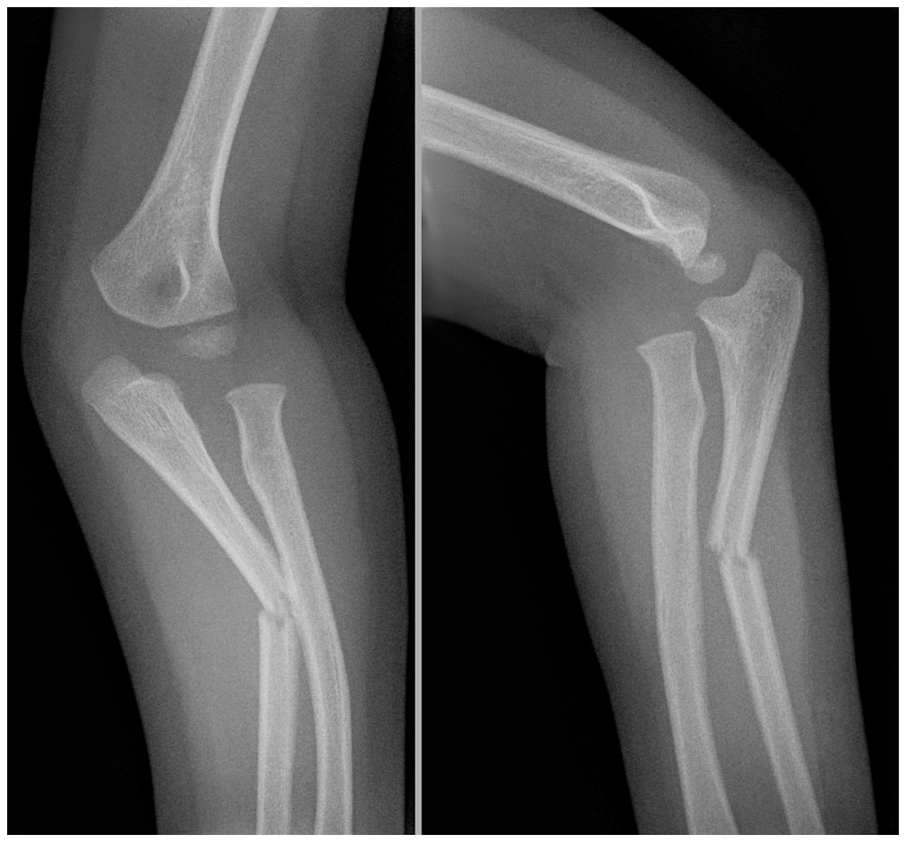 AP and lateral left forearm X-rays after playground fall