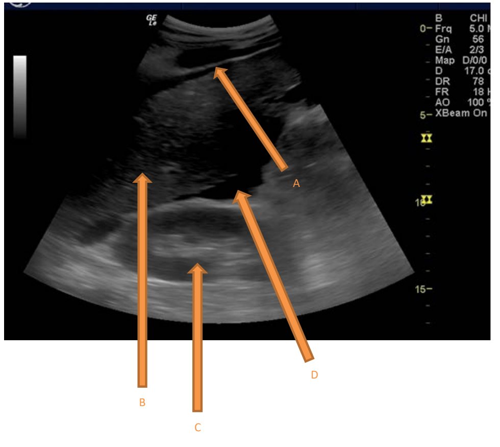 Right upper quadrant FAST image with labels A-D