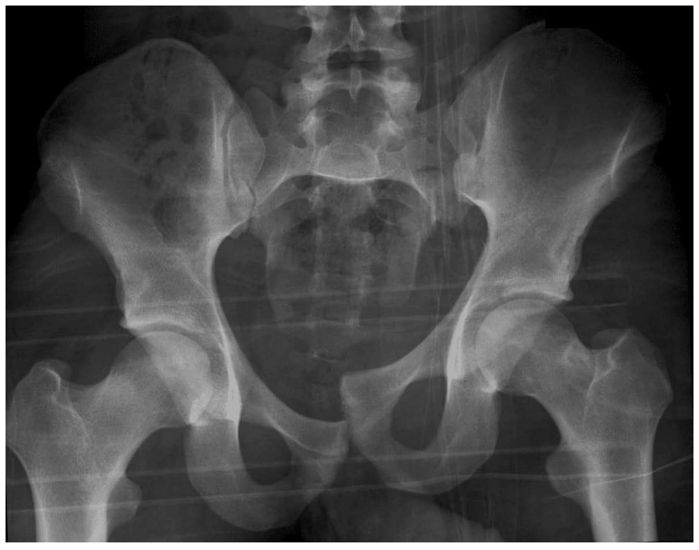 Pelvic X-ray after fall from height