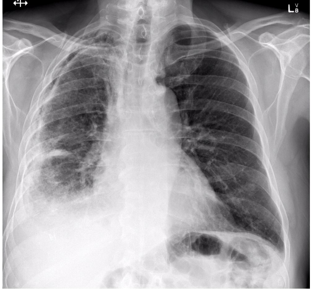 Chest X-ray for pleuritic chest pain and dyspnoea