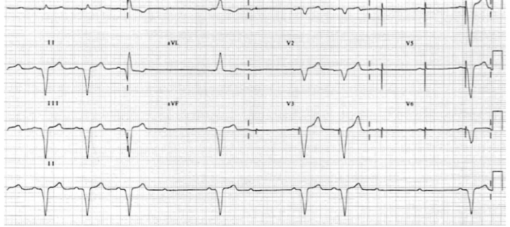 ECG for recurrent syncope in a patient with a pacemaker
