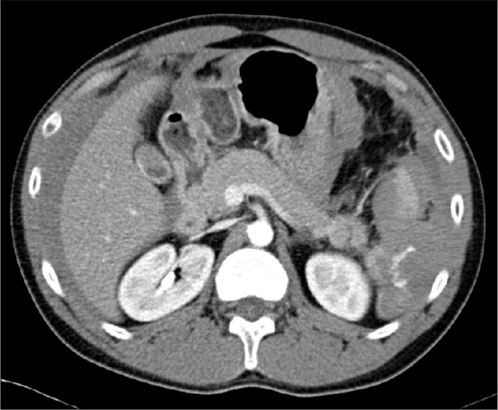 Contrast CT abdomen slice after motorcycle crash