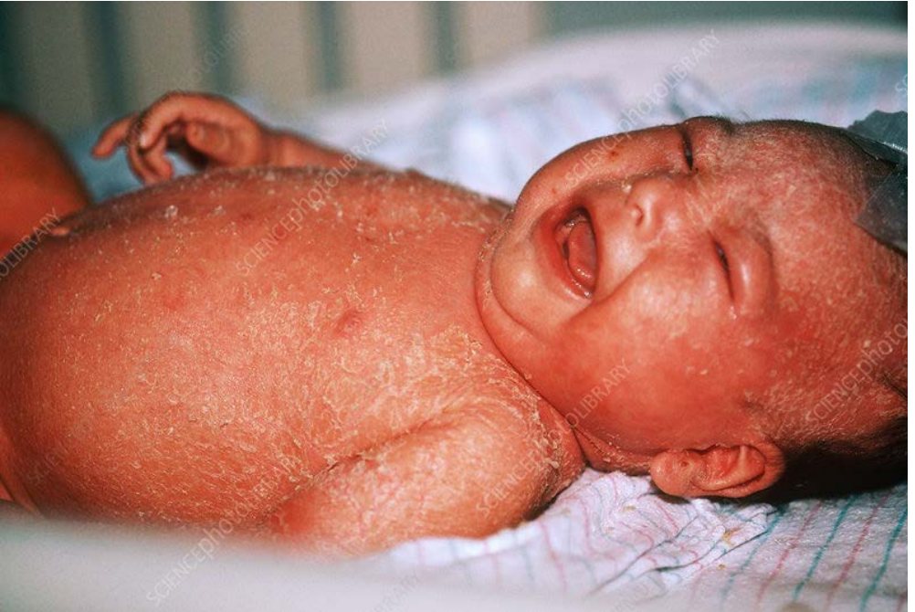 Clinical photograph of a febrile infant with rash