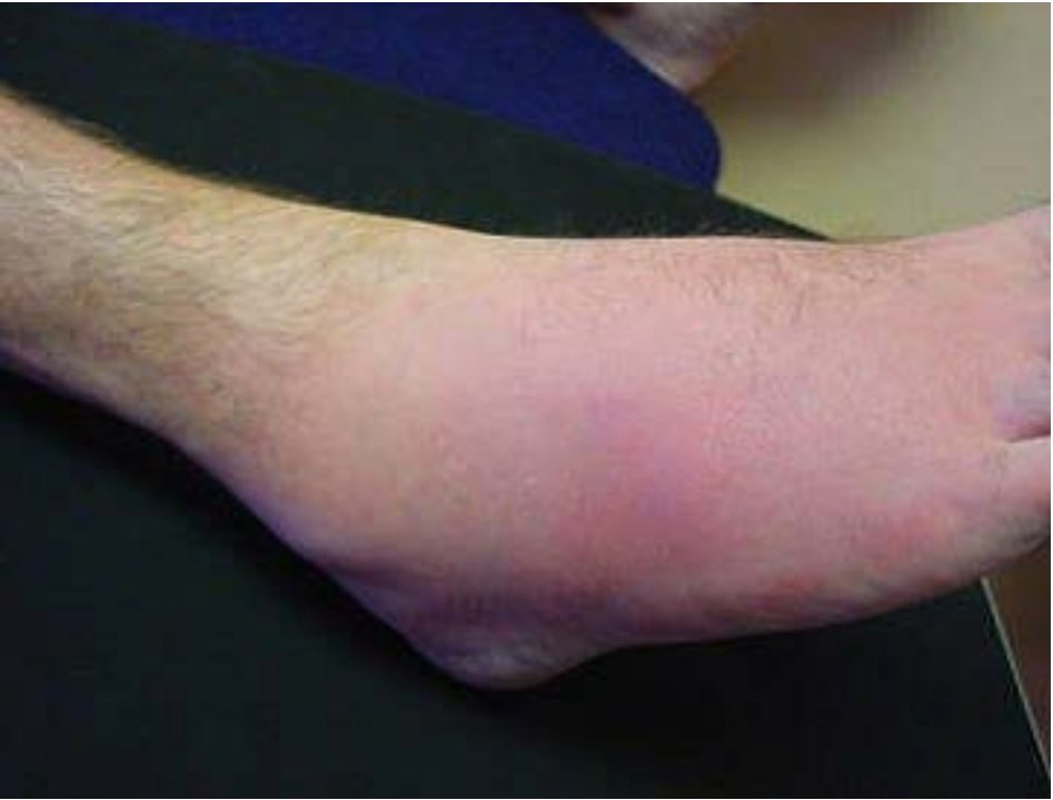 Clinical photograph of atraumatic ankle pain