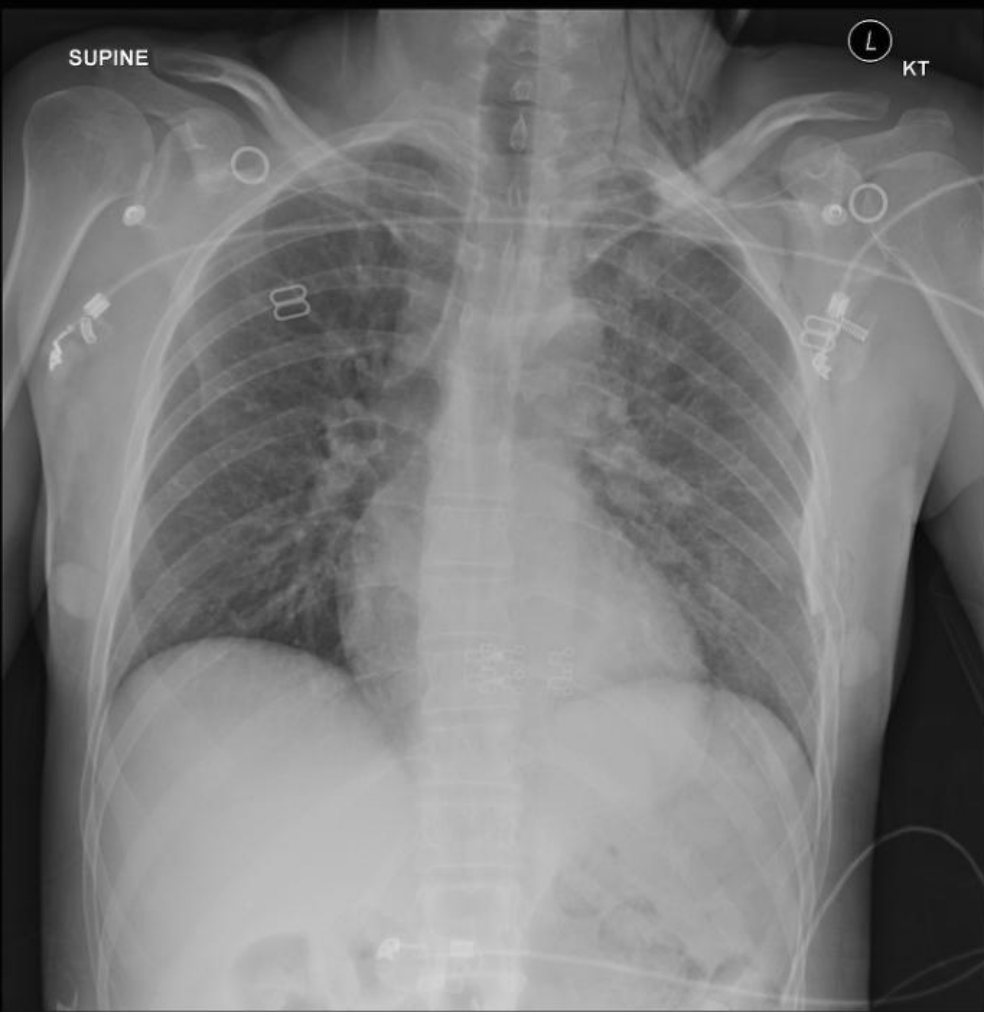 Supine chest X-ray after blunt chest trauma