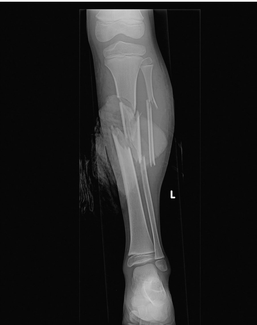 AP leg X-ray after horse-riding fall