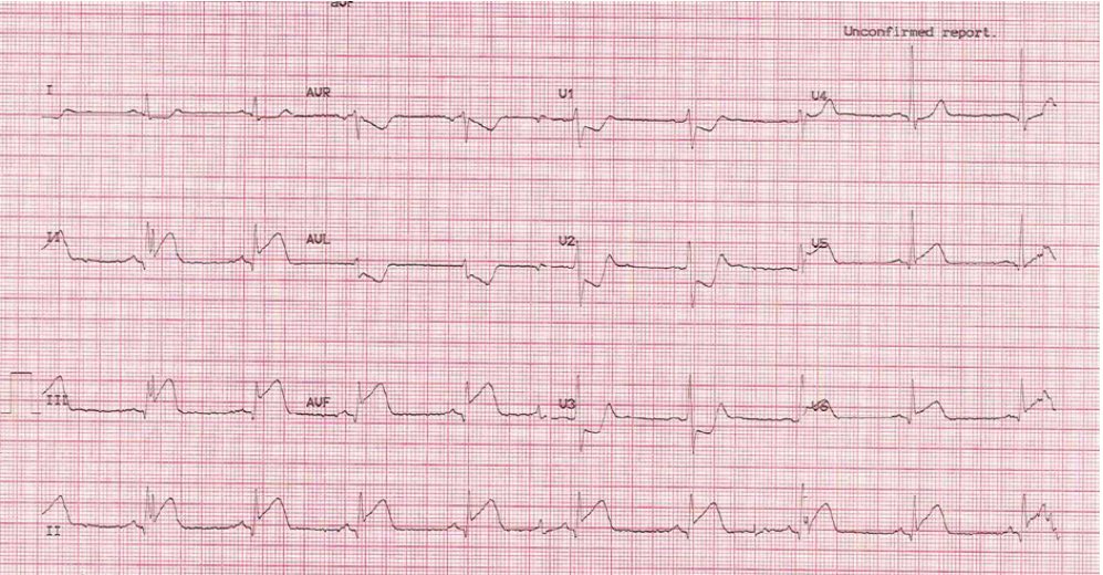 ECG after thrombolysis for myocardial infarction
